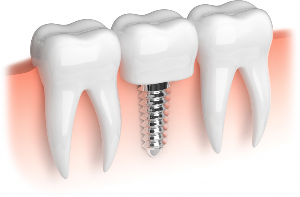 Patient Perspective: What to Expect After a Sinus Lift