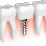 Patient Perspective: What to Expect After a Sinus Lift